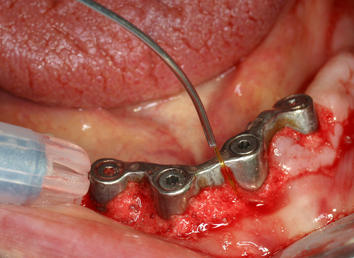 Infection généralisée des implants dentaires